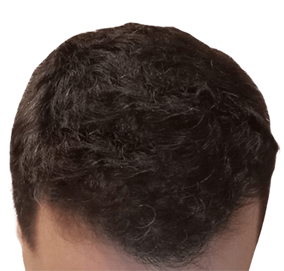 hair of a man after transplant