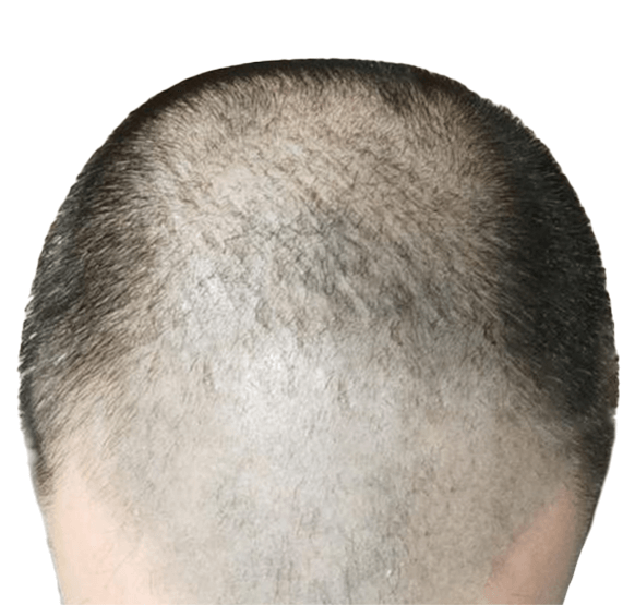 hair before transplant