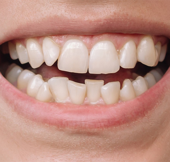 smiling with twisted teeth set